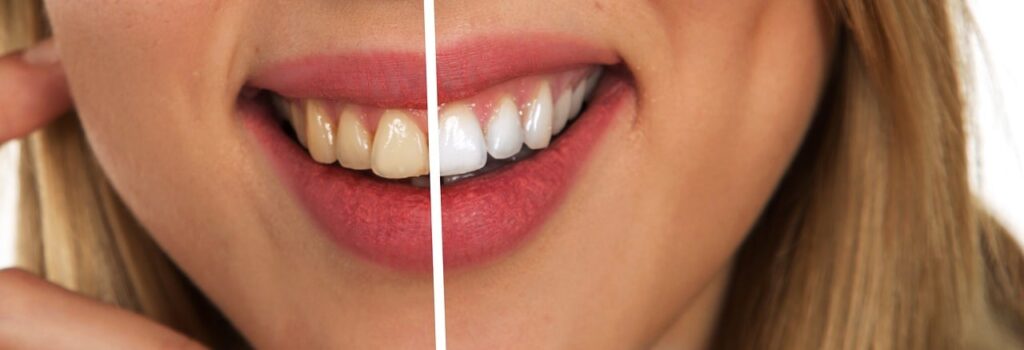 Clareamento Dental, antes e depois